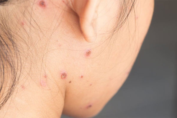 Chăm sóc trẻ bị thủy đậu như thế nào để tránh những biến chứng xảy ra?