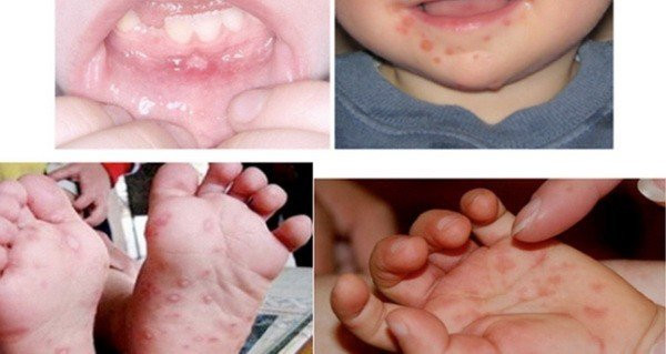 Cần chủ động phòng ngừa khi bệnh tay chân miệng có chiều hướng gia tăng