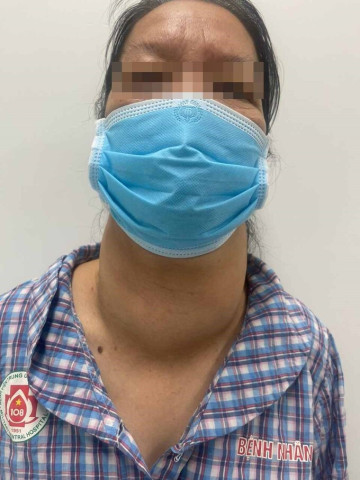 Phẫu thuật thành công khối u tuyến giáp khổng lồ cho 1 nữ bệnh nhân