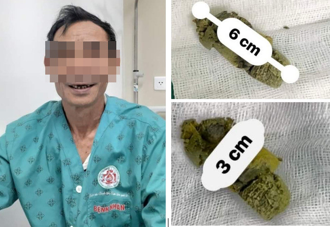 Hy hữu chuyện bệnh nhân mắc dị vật trong dạ dày do ăn măng không nhai từ Tết