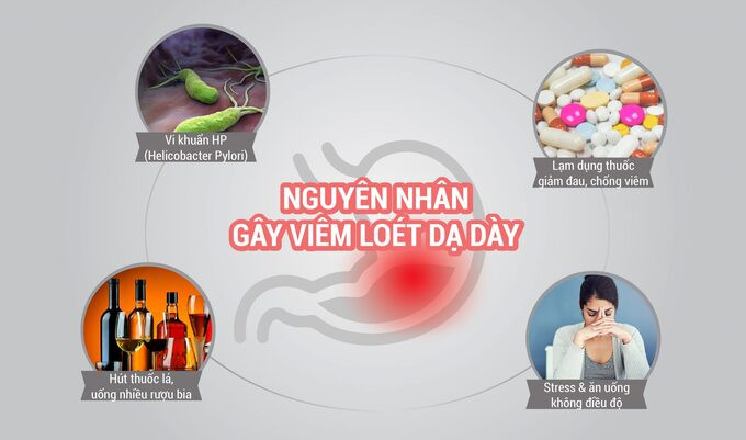 Nguyên nhân, triệu chứng và cách phòng ngừa bệnh thủng hành tá tràng, viêm phúc mạc do áp lực