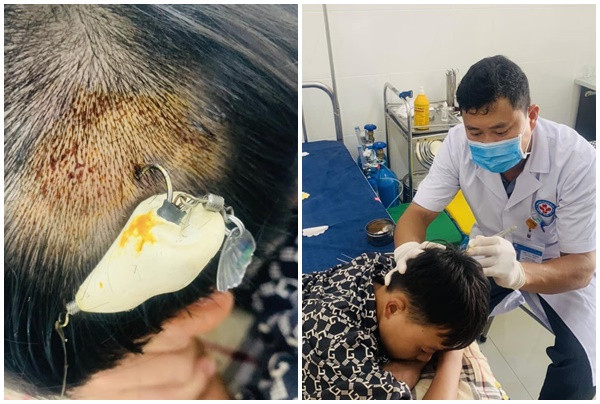 Quảng Ninh xử trí thành công 2 trường hợp trẻ em đi câu cá không may bị lưỡi câu móc vào đầu