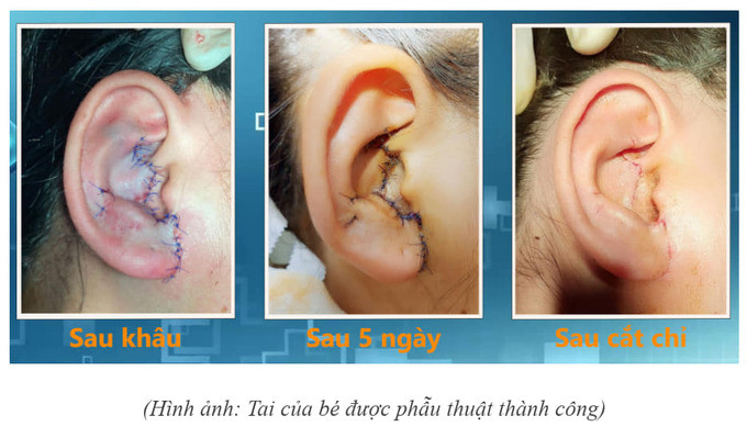 Cần Thơ phẫu thuật khâu nối thành công 1 trường hợp đứt vành tai phức tạp sau tai nạn giao thông