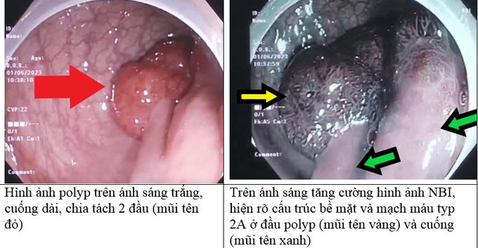 Hy hữu phát hiện 1 trường hợp polyp đại trực tràng có đôi