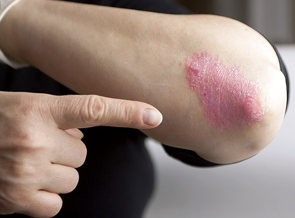 Chiết xuất vani có thể phòng trị vẩy nến
