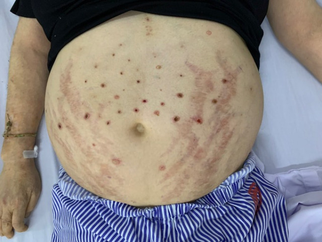 Hà Nội: Chữa trị thầy lang bằng phương pháp ong châm, một phụ nữ nhập viện trong tình trạng nhiều vết mụn mủ ở bụng và chân
