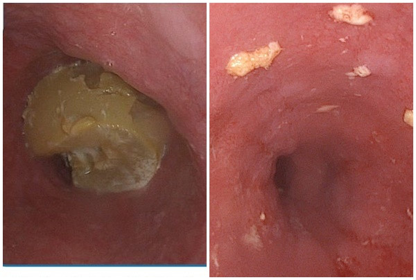 Long An cấp cứu một bệnh nhân nam bị hóc cục gân bò trong lúc đang ăn sáng