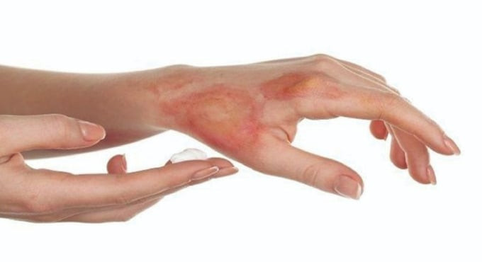 Vitamin D giúp vết thương do bỏng mau lành