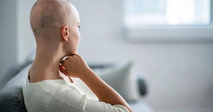 Tình trạng rụng tóc của bệnh nhân ung thư khi điều trị hóa trị