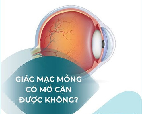 Giác mạc mỏng có mổ cận được không?