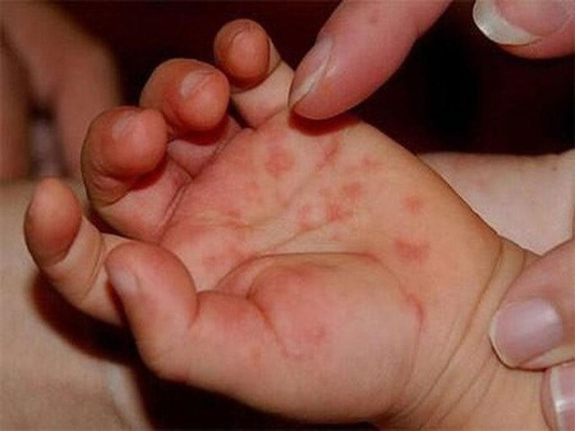 Những biến chứng của bệnh tay chân miệng