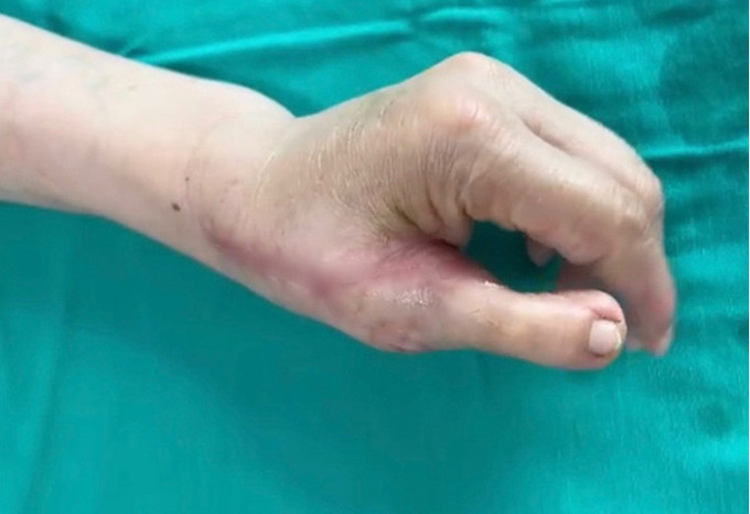 Hà Nội tạo hình ngón tay cái từ ngón chân cho bệnh nhân bị tai nạn lao động