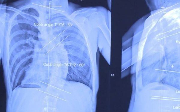 Cong vẹo cột sống dấn đến biến dạng cơ thể cần được phát hiện và điều trị sớm