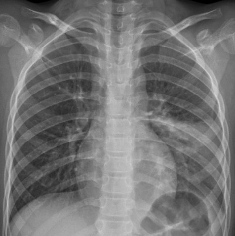 Những điều cần biết về viêm phổi do nhiễm vi khuẩn Mycoplasma