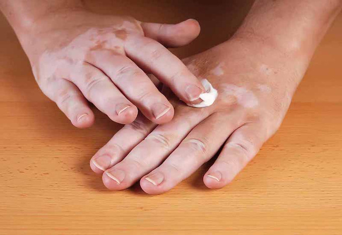 Nước ta có khoảng 1 triệu người mắc bệnh bạch biến