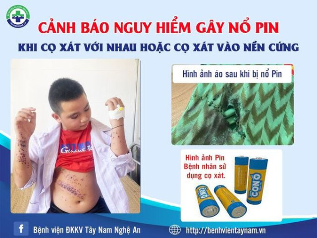 Nghệ An: Bé trai 12 tuổi cọ xát 2 viên pin vào nhau phát nổ khiến tay và bụng bị thương