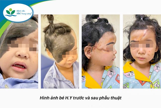 Bé gái 5 tuổi bị u hắc tố khổng lồ trên mặt 3 lần phẫu thuật trong vòng 3 năm