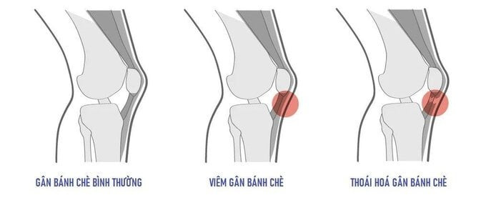 Nguyên nhân và triệu chứng viêm gân bánh chè