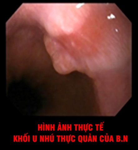 Phú Thọ: Một nam bệnh nhân thường xuyên ợ nóng, trào ngược đi khám phát hiện u nhú thực quản