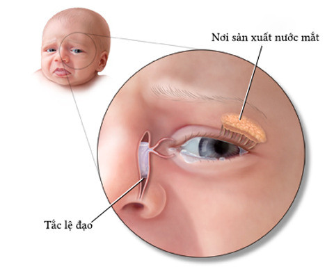 Tìm hiểu về triệu chứng tắc lệ đạo