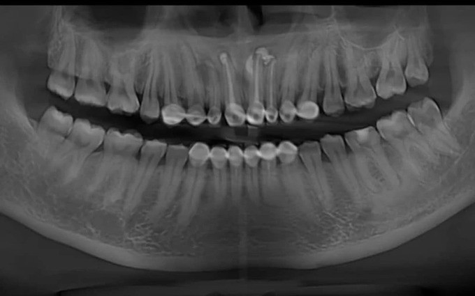 Bắc Giang tiếp nhận điều trị cho một bệnh nhân bị nang xương hàm trên