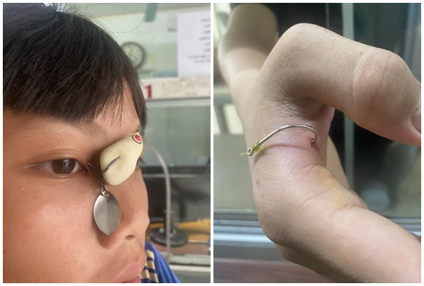 Tuyên Quang: Đi câu cá, các “cần thủ nhí” bị lưỡi câu móc vào mí mắt và ngón tay