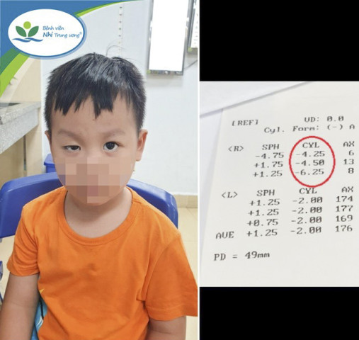 Nguyên nhân, biện pháp và cách điều trị sụp mi