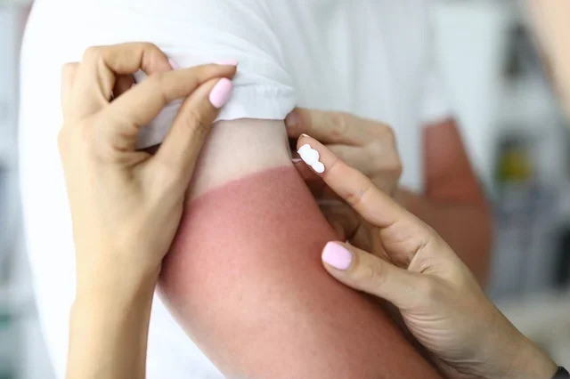 Thuốc mỡ trị bỏng: 7 lựa chọn tốt nhất và khi nào nên sử dụng