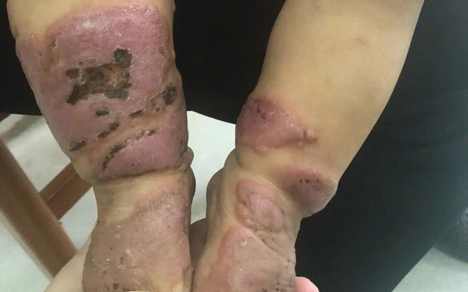 Cao Bằng: Bệnh nhi 11 tuổi bị viêm da cơ địa nặng do người nhà tự ý sử dụng lá cây điều trị bệnh
