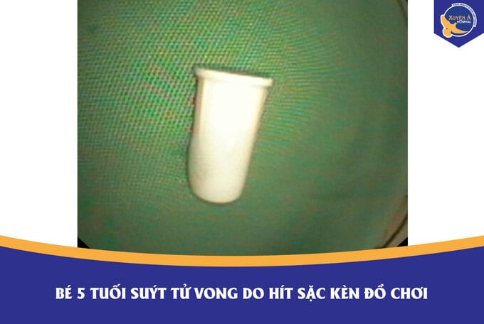Tây Ninh: Bé 5 tuổi suýt tử vong do hít sặc kèn đồ chơi