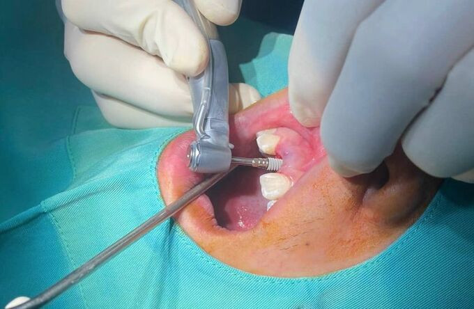 Phú Thọ triển khai kỹ thuật cấy ghép Implant hồi sinh nụ cười và nâng cao chất lượng cuộc sống cho người bệnh
