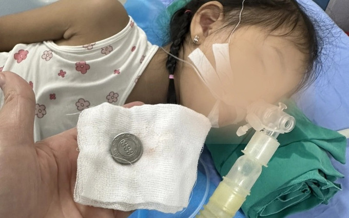 Vĩnh Phúc cấp cứu thành công bé gái 3 tuổi nuốt dị vật là đồng xu mắc trong thực quản