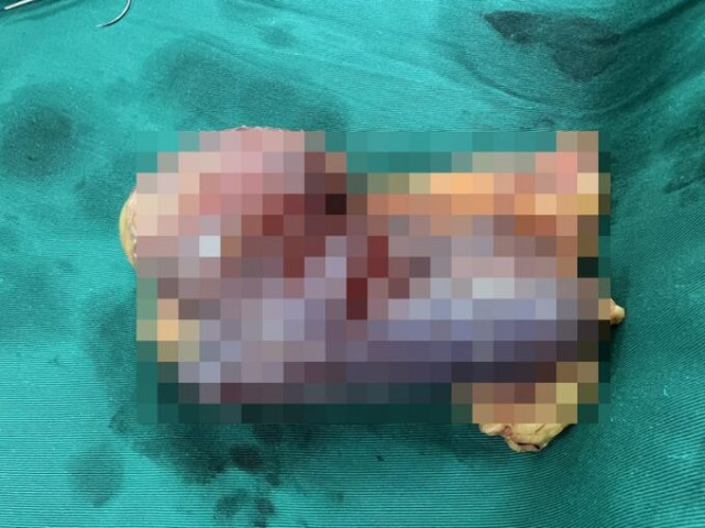 Lào Cai phẫu thuật thành công 3 ca bệnh u thận, ung thư gan và ung thư dạ dày cho 3 bệnh nhân