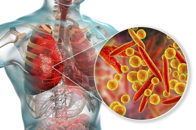 Nguyên nhân và dấu hiệu nhận biết viêm phổi do Mycoplasma pneumoniae