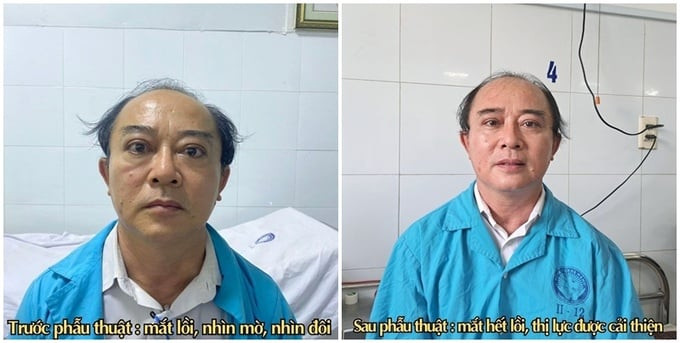 Đà Nẵng phẫu thuật giải áp hốc mắt điều trị bệnh nhãn giáp