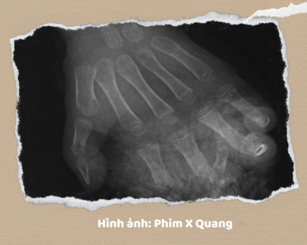 Quảng Ninh: Bé trai 3 tuổi bị máy thái rau lợn cắt cụt đốt ngón tay