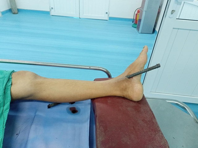 Quảng Nam cấp cứu trường hợp hy hữu bị cọc sắt dùng làm cốt đổ trụ bê tông đâm xuyên qua cẳng chân
