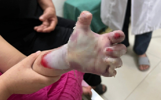 Nghệ An  tiếp nhận nhiều trường hợp trẻ bị dập nát bàn tay do cuốn tay vào máy ép mía