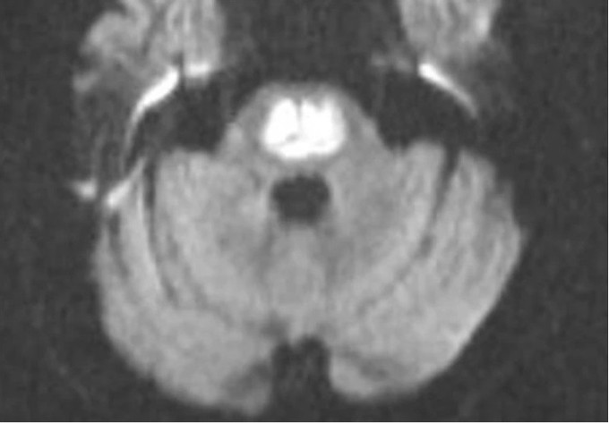 Phú Thọ điều trị cho bệnh nhân mắc hội chứng tổn thương cầu não do hủy myelin thẩm thấu