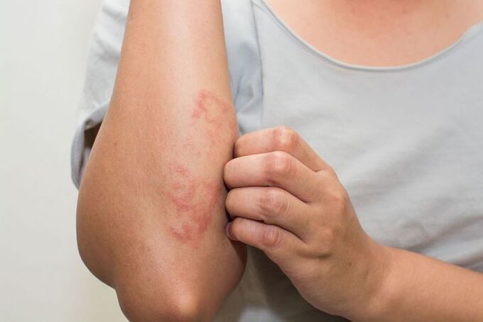 Phơi nắng giảm triệu chứng chàm eczema