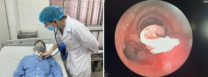 Cần Thơ nội soi thành công gắp dị vật là đoạn khăn giấy trong lòng phế quản bệnh nhân