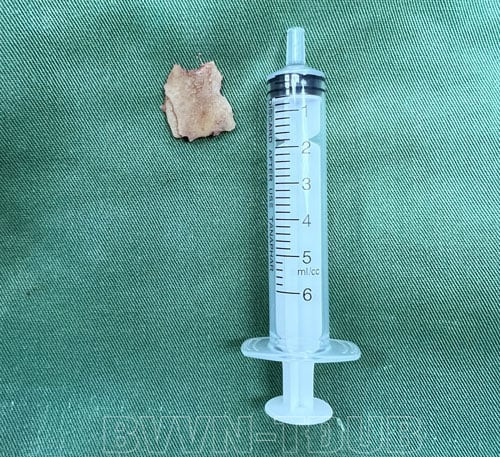 Quảng Ninh gắp 1 mảnh xương lợn sau 1 năm nằm trong phế quản của bệnh nhân