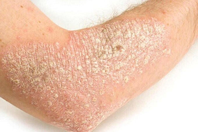 Bệnh vảy nến có điều trị dứt điểm được không?