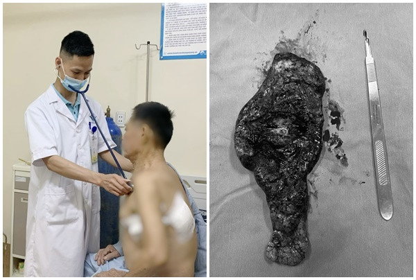 Phú Thọ phẫu thuật giải thoát ung thư phổi trái có kích thước lớn cho nam bệnh nhân 61 tuổi