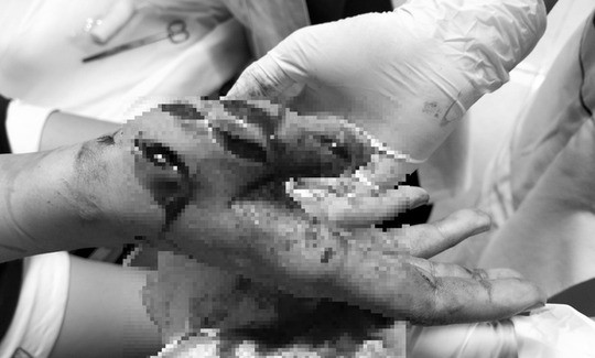 Hà Nội: Cô gái 17 tuổi bị máy xay đa năng cắt vào tay khiến đứt gân