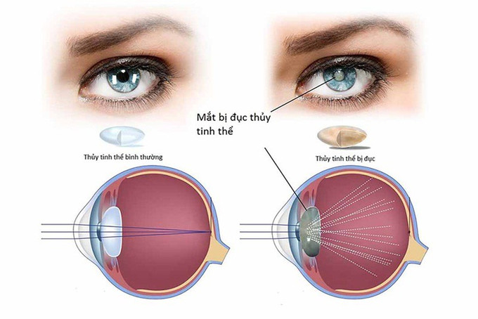 Công nghệ phẫu thuật Phaco - khắc phục nhược điểm điều trị đục thủy tinh thể