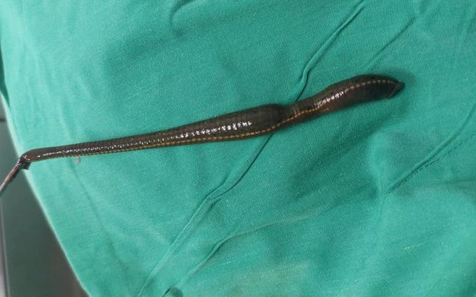 Tây Ninh nội soi gắp ra một con đỉa dài khoảng 12cm trong niệu đạo của bệnh nhân 70 tuổi