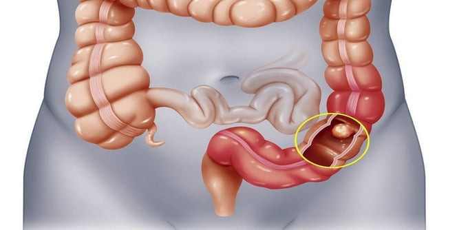 Bài thuốc hỗ trợ điều trị bệnh ung thư ruột