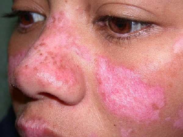 Nguyên nhân, biểu hiện và cách điều trị bệnh Lupus ban đỏ hệ thống