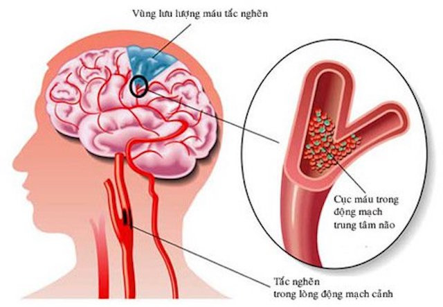 Đề phòng đột quỵ ở người cao tuổi